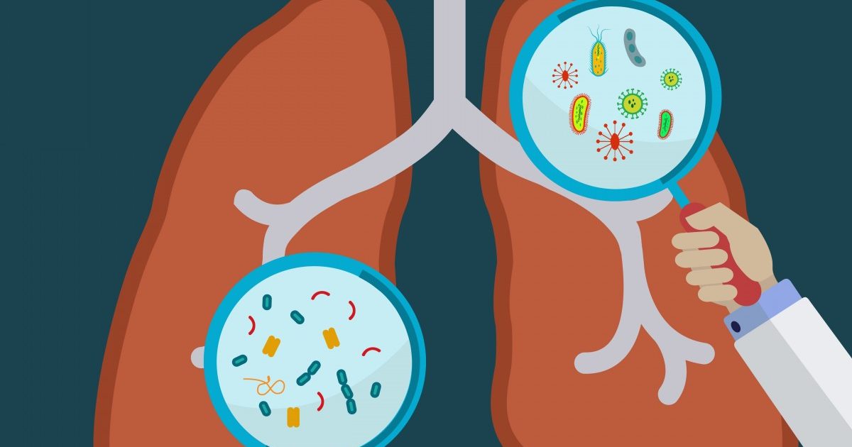 Sarcoidosis Affected by Birdrelated Lung Disease Reported