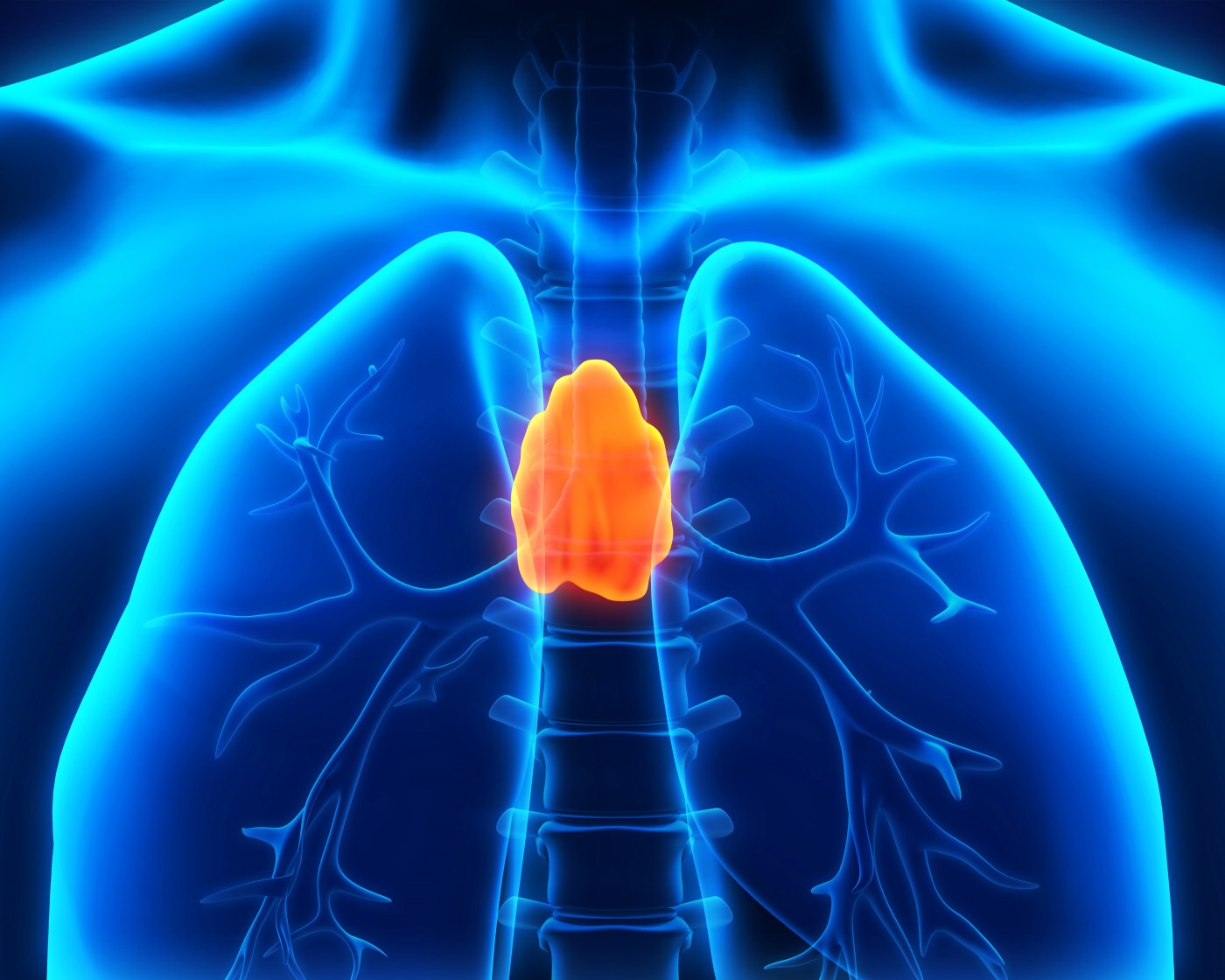 thymus in sarcoidosis