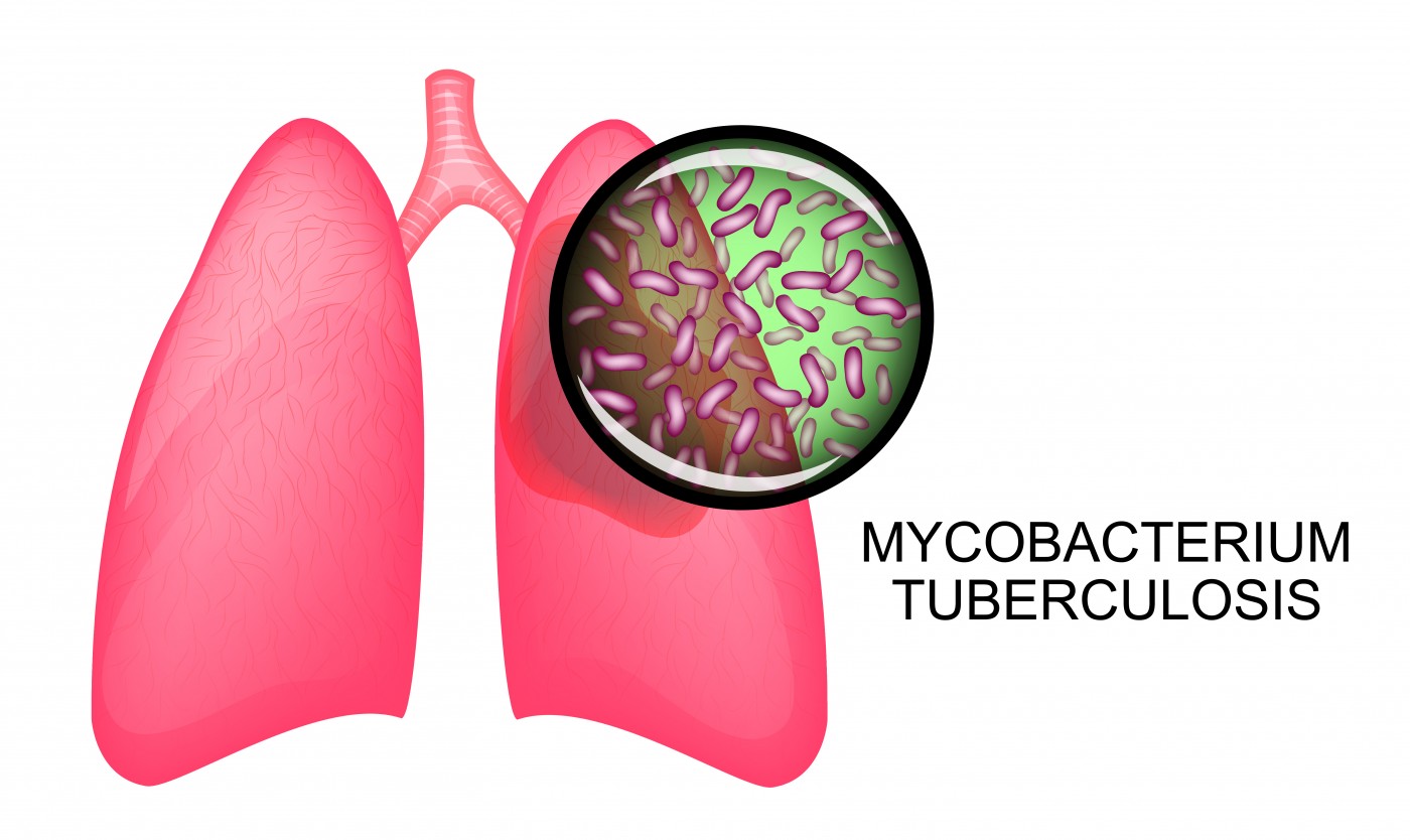 sarcoidosis and tuberculosis