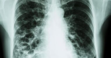 rare lung disease and sarcoidosis