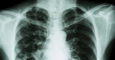 rare lung disease and sarcoidosis