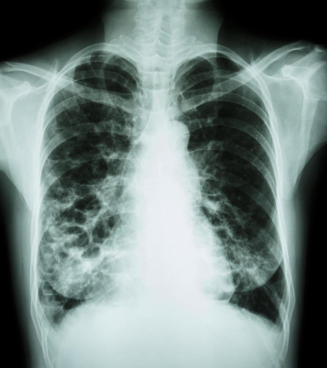 rare lung disease and sarcoidosis