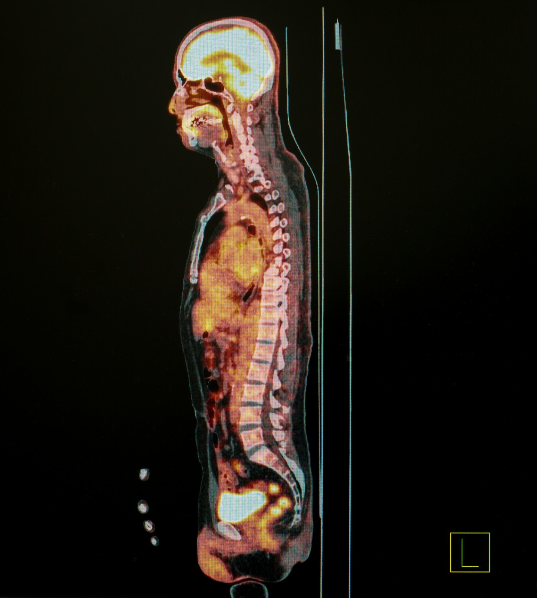 Spinal MRI scans