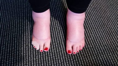 Fear \ Sarcoidosis News \ Photo shows a pair of very swollen feet