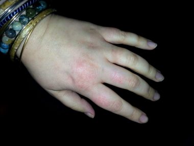 Fear\ Sarcoidosis News \ Photo of a left hand, swollen and inflamed