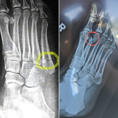 X-rays of Kerry's right foot, highlighting (left) fifth metatarsal fracture in 2021 and (right) second metatarsal fracture in 2022