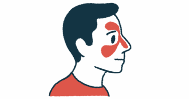 An illustration of a person's head shows redness in the nose and above and beneath the eye to signify inflammation of the nasal cavity.