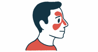An illustration of a person's head shows redness in the nose and above and beneath the eye to signify inflammation of the nasal cavity.