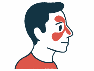 An illustration of a person's head shows redness in the nose and above and beneath the eye to signify inflammation of the nasal cavity.