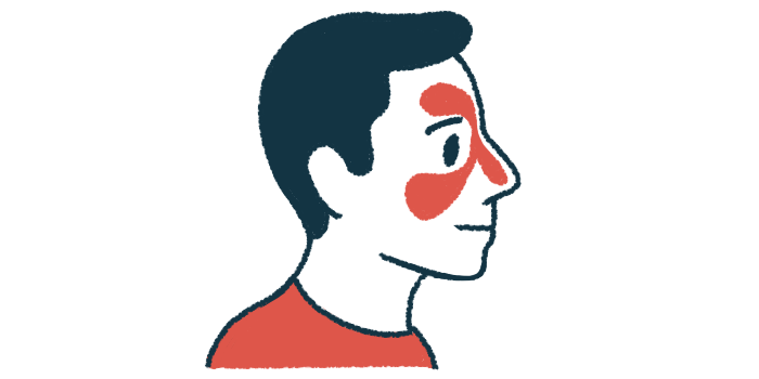 An illustration of a person's head shows redness in the nose and above and beneath the eye to signify inflammation of the nasal cavity.